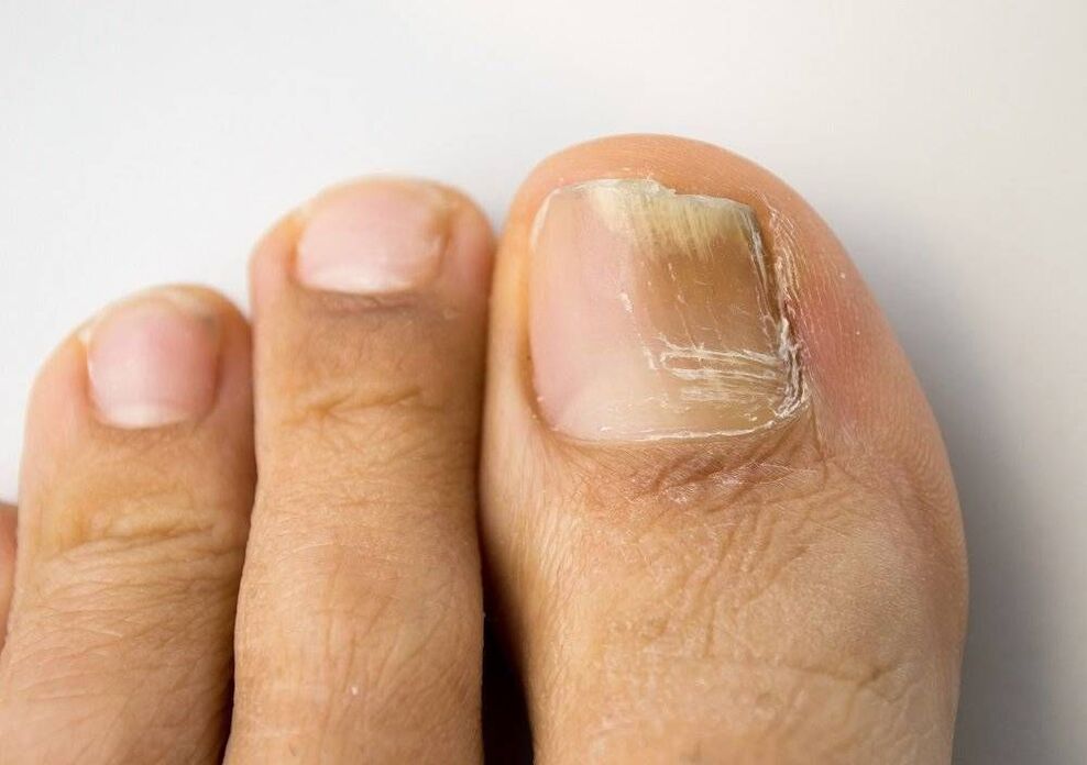 Types of big toe fungal infections