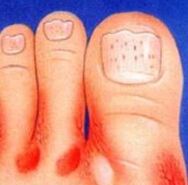 Fungus on the legs