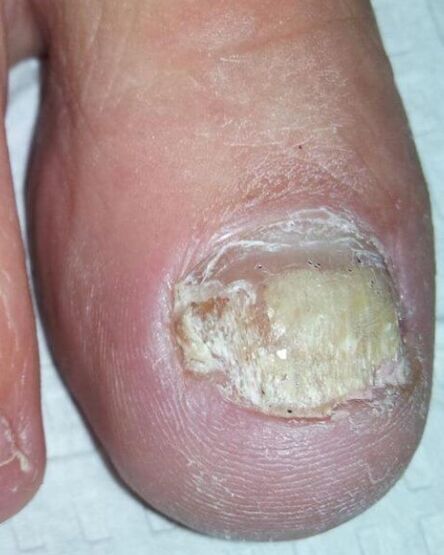 Fungus on the legs
