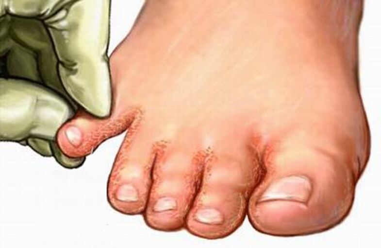 Fungus on the legs