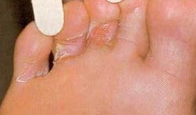 Skin lesions of moxasis in soles