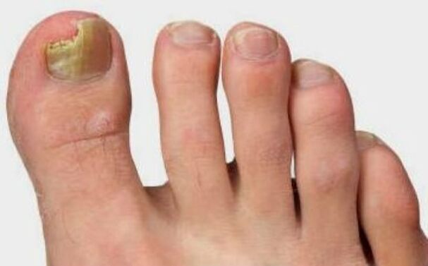 Fungus on the thumb of the leg