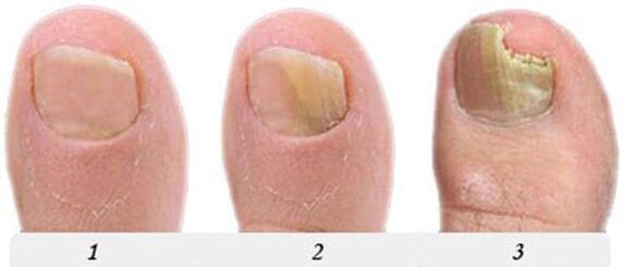 The process of developing fungi on the thumb