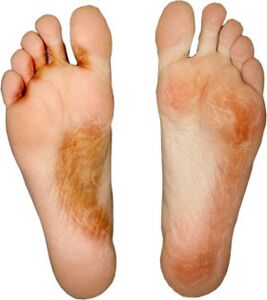 Heal the fungus on your fingers, don't pick it up again