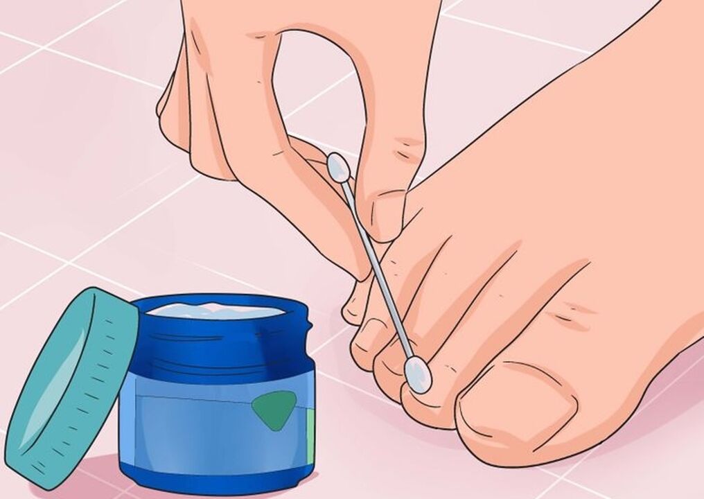 Healing nail fungi
