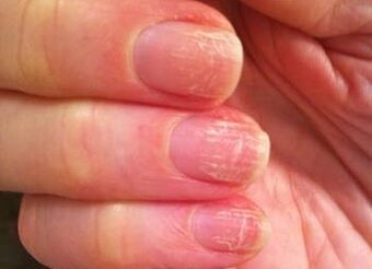 The initial stage of fungi on nails