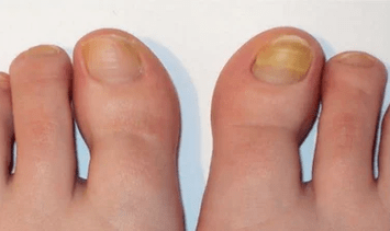 The initial stage of nail fungus