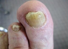 Causes of fungi appearing on nails