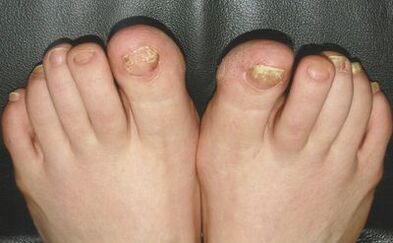 Signs of fungus on nails
