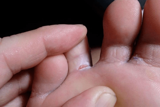 Appearance of bubble formations on feet