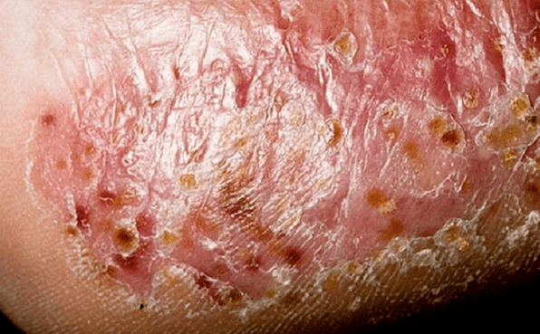 Foot fungus