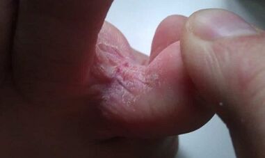 The stage of fungal development between toes