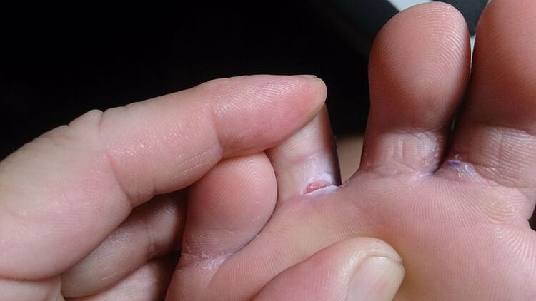 Foot fungus