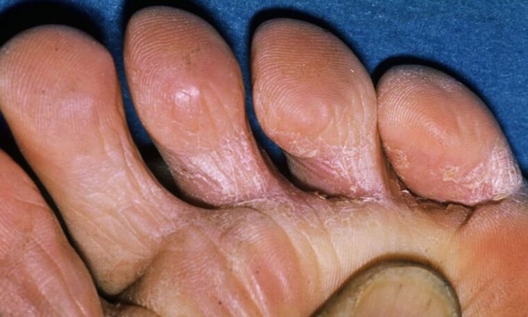 Various types of leg fungus
