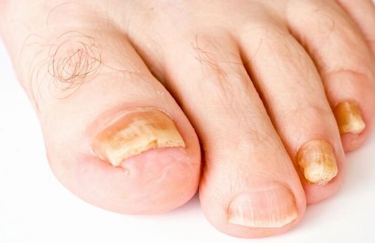 Yellow toenails due to fungus