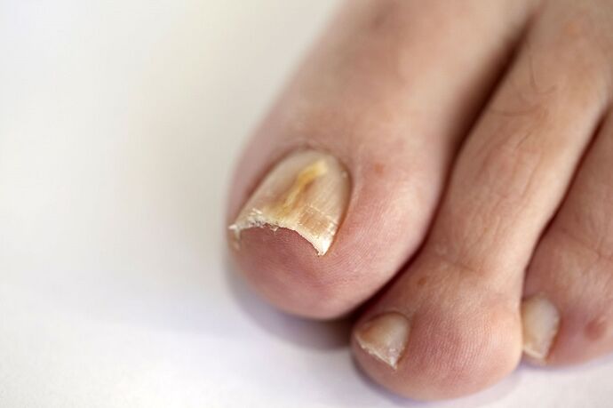 Nail infection caused by fungal infection