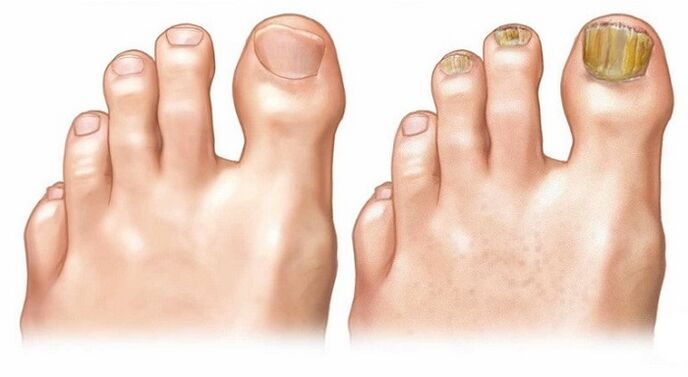 Healthy fingernail and toenail fungus