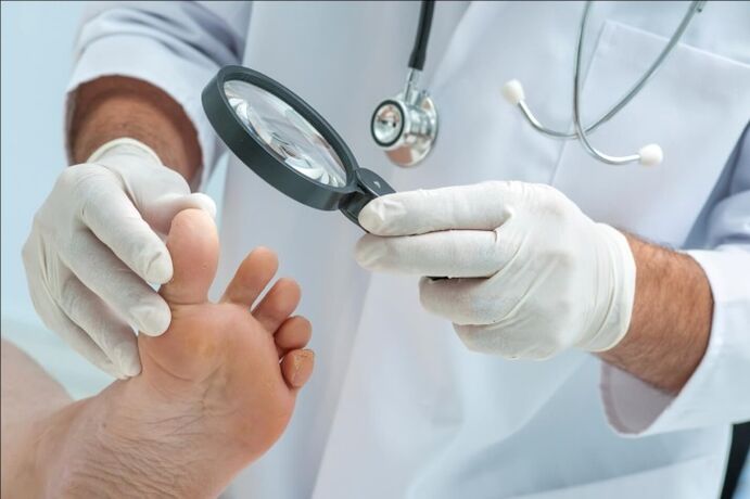 Doctors check before prescribing toenail fungus