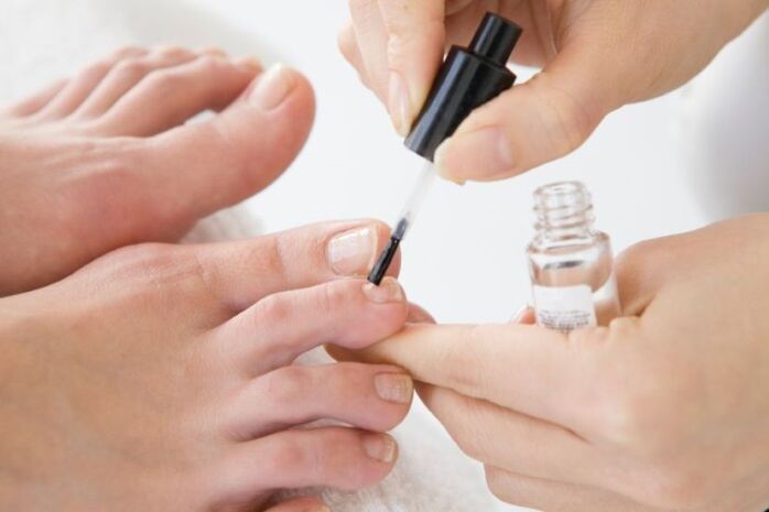 Frequent application of medical varnish will speed up the treatment of onychomycosis