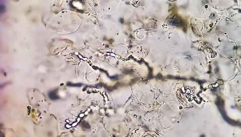 Fungi under the microscope – the culprit of fungal foot diseases