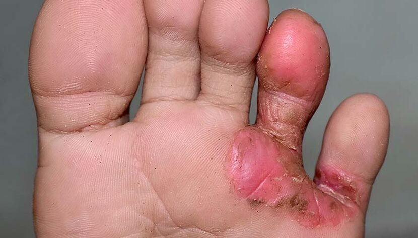 Manifestations of interdigital mycosis of the feet