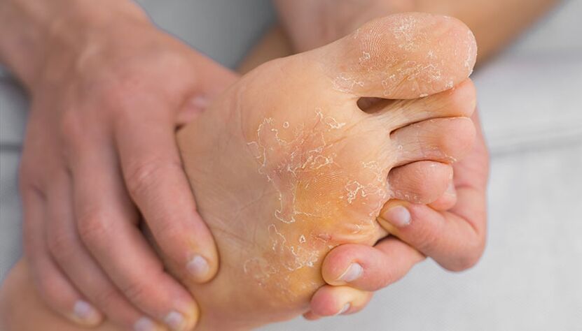 Peeling skin and itching are symptoms of foot fungus