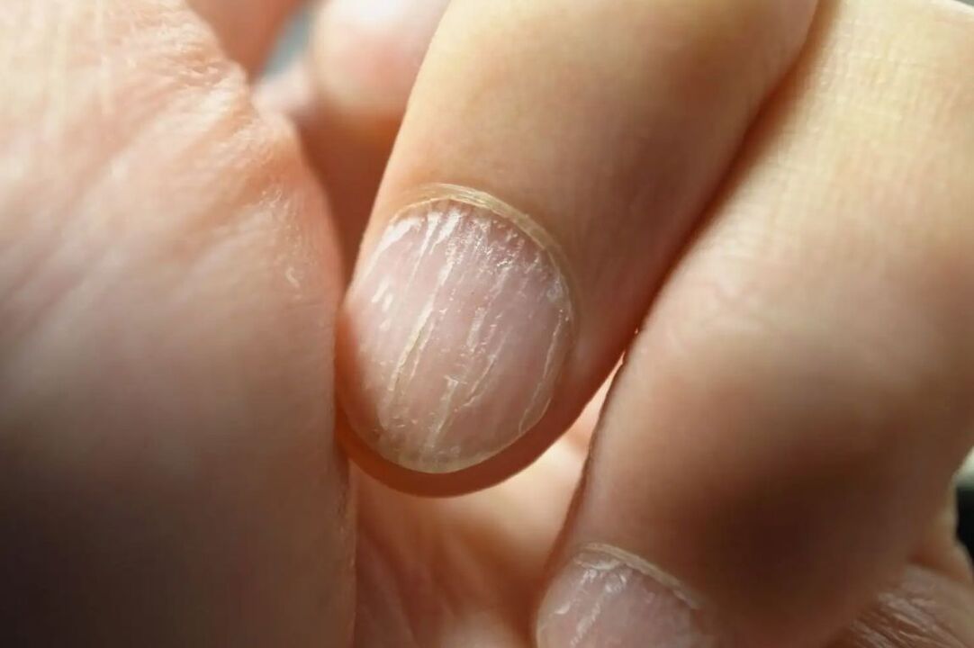 Monotrichosis on the nails