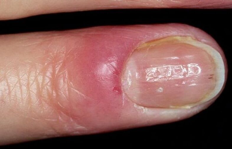 Nail anorexia