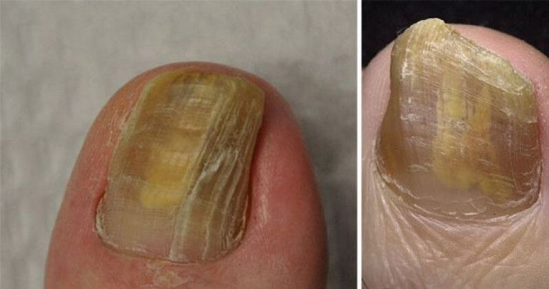 Nail malnutrition