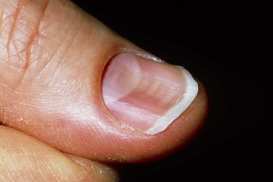 Onychomycosis on the nails