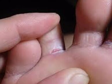 have toe fungus